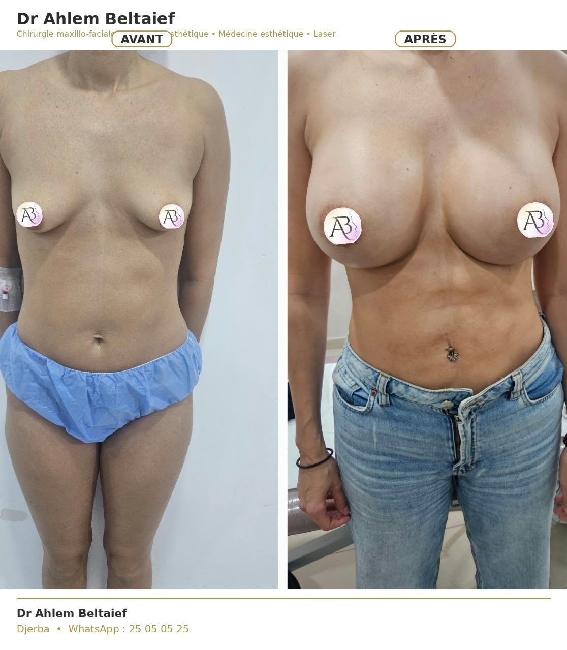 Avant / après augmentation mammaire par prothèses, cas 3