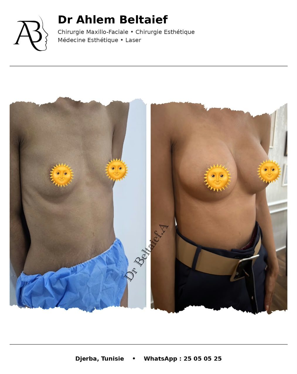 Avant / après augmentation mammaire, vue 3