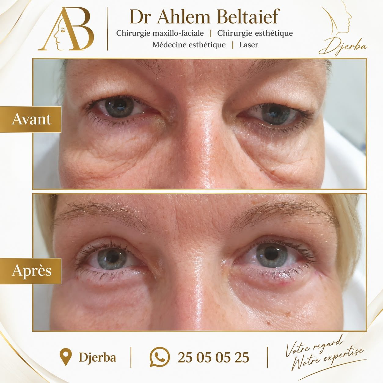 Avant / après blépharoplastie, cas 1