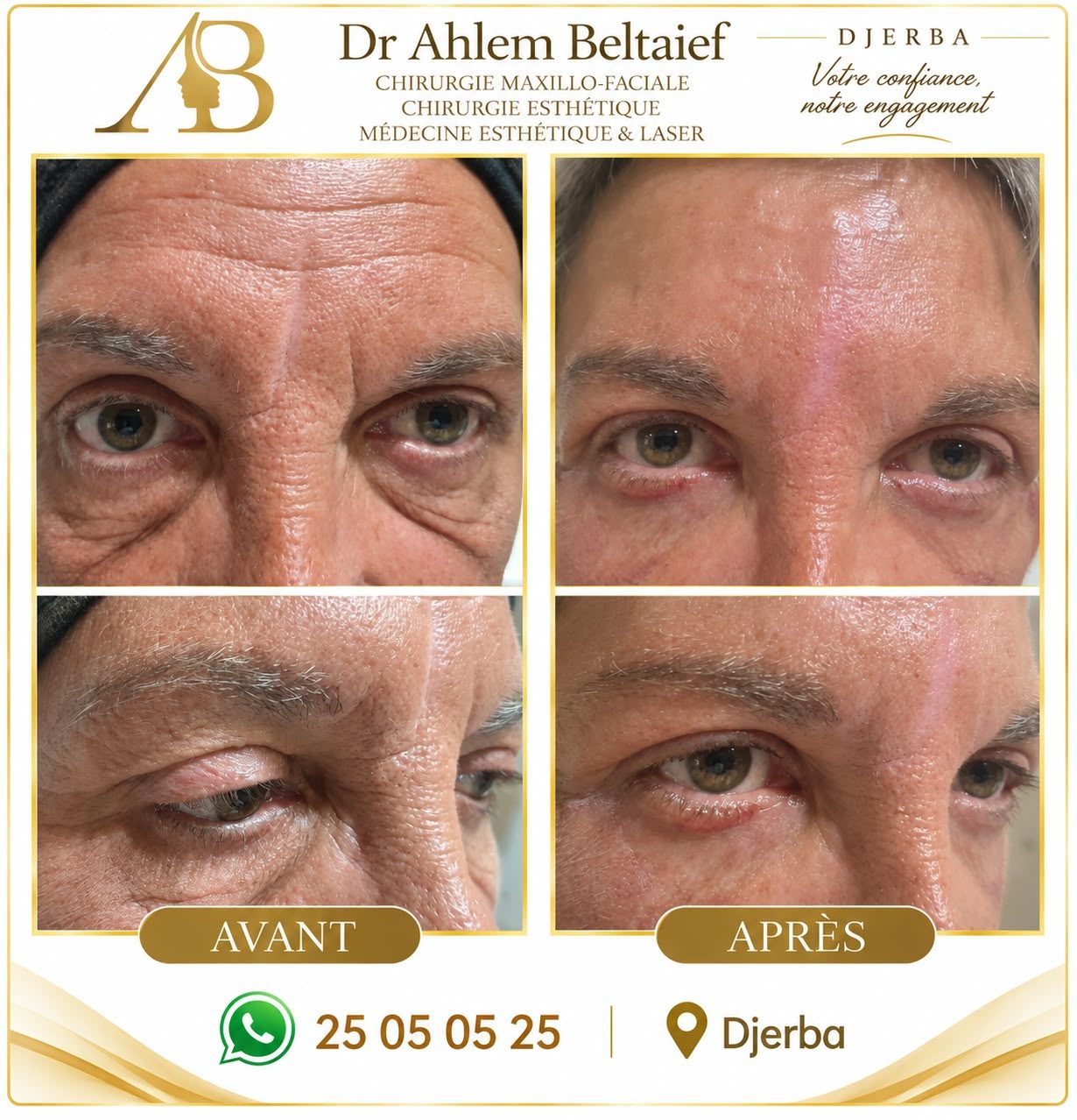 Avant / après blépharoplastie, cas 3