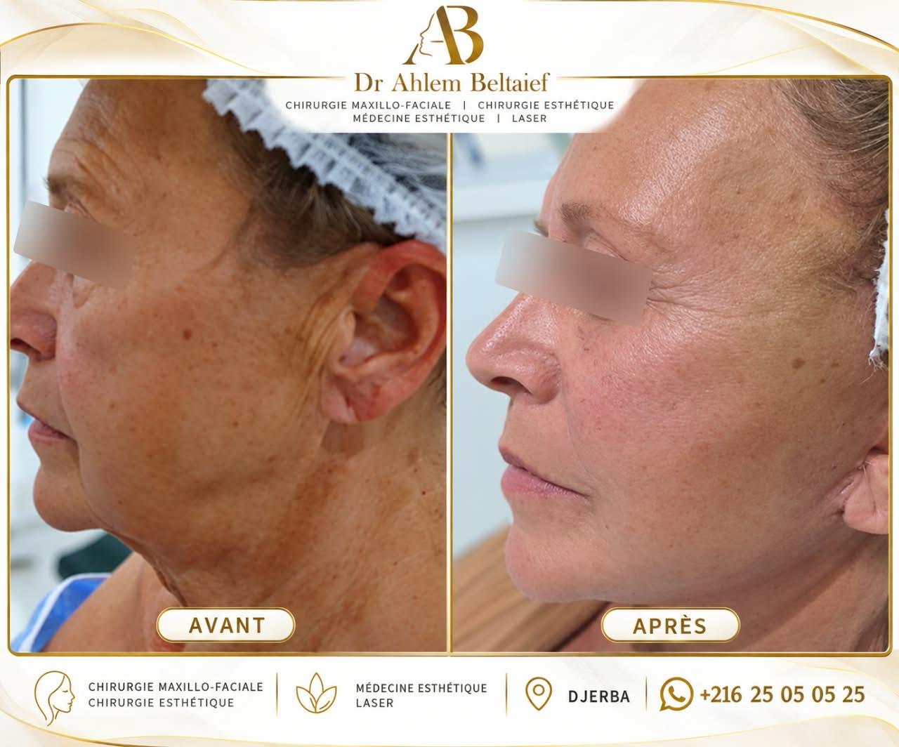 Avant / après lifting cervico-facial, vue de profil