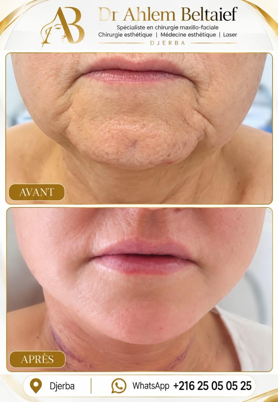Avant / après lifting cervico-facial : ovale du visage et cou