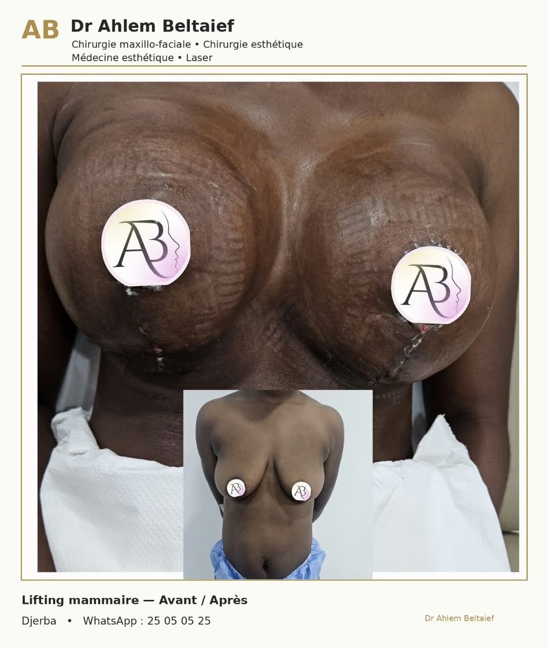 Avant / après lifting mammaire, vue 1