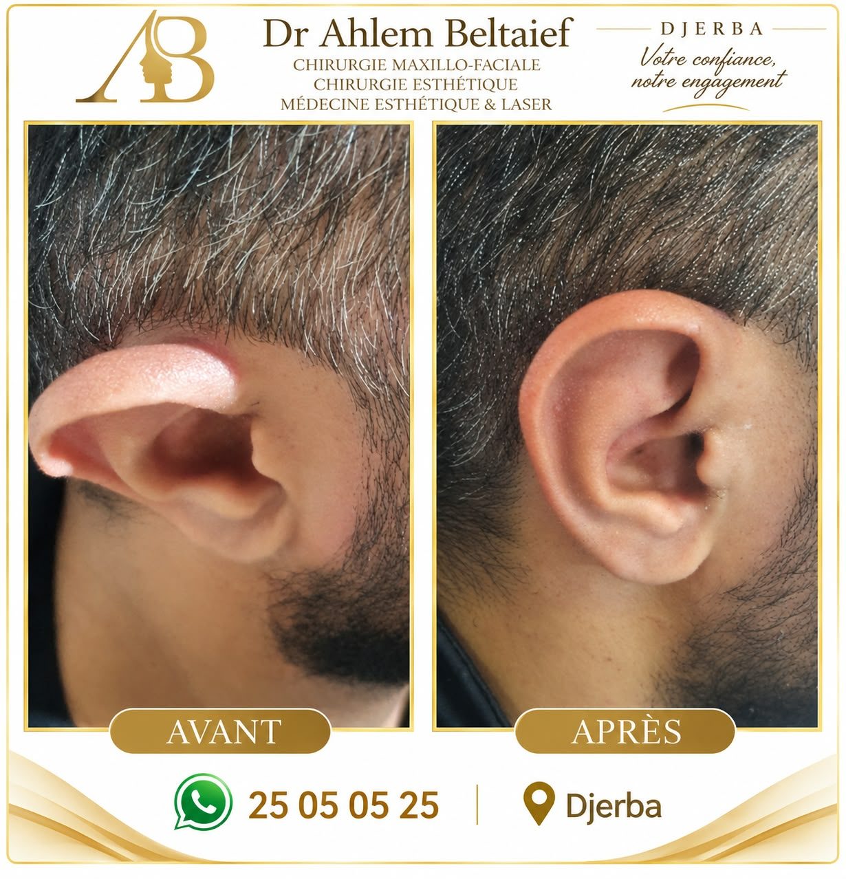 Avant / après otoplastie, cas 2