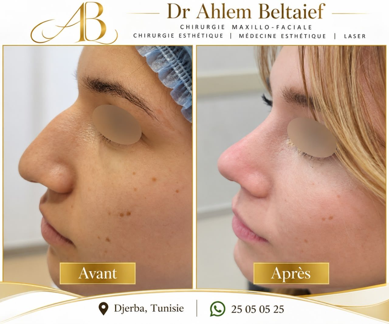 Avant / après rhinoplastie, vue de profil