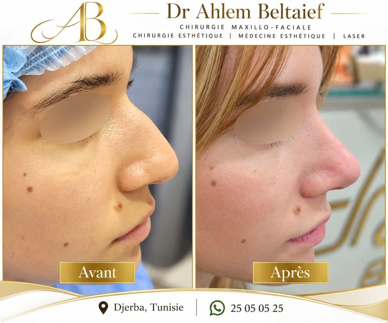 Avant / après rhinoplastie, autre vue