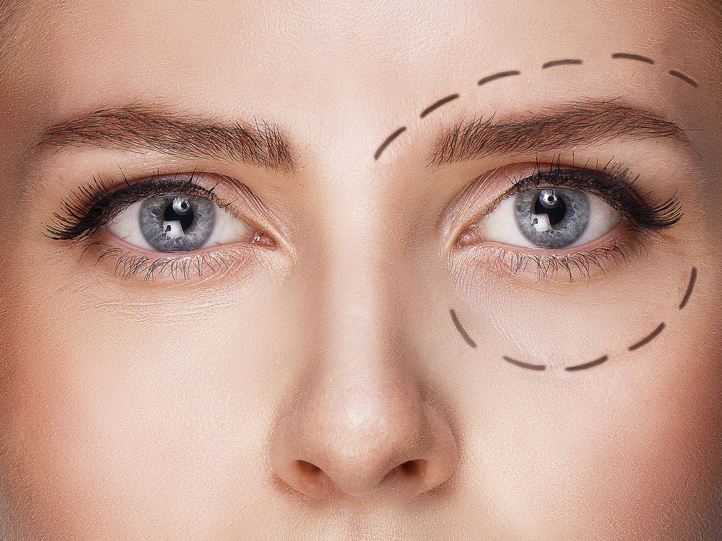 Blépharoplastie Médicale