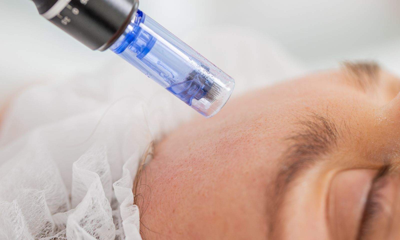Microneedling