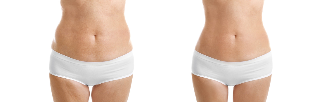 liposculpture