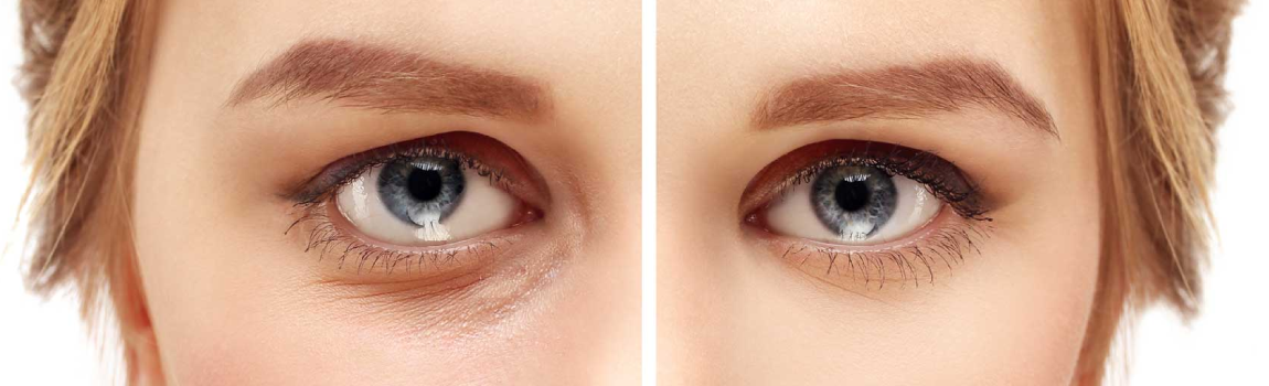 blepharoplastie-medicale